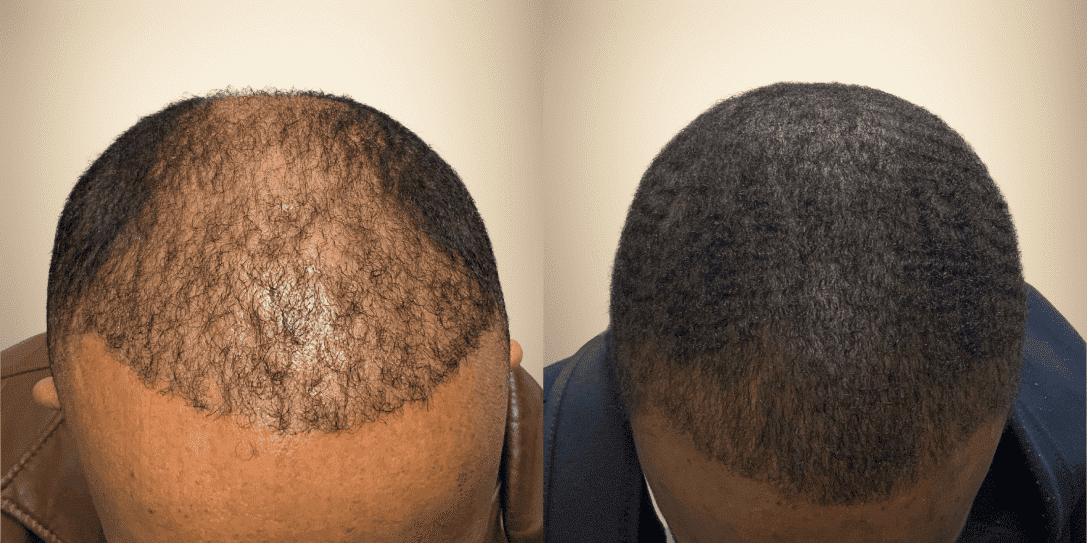 before-and-after-hair-restoration