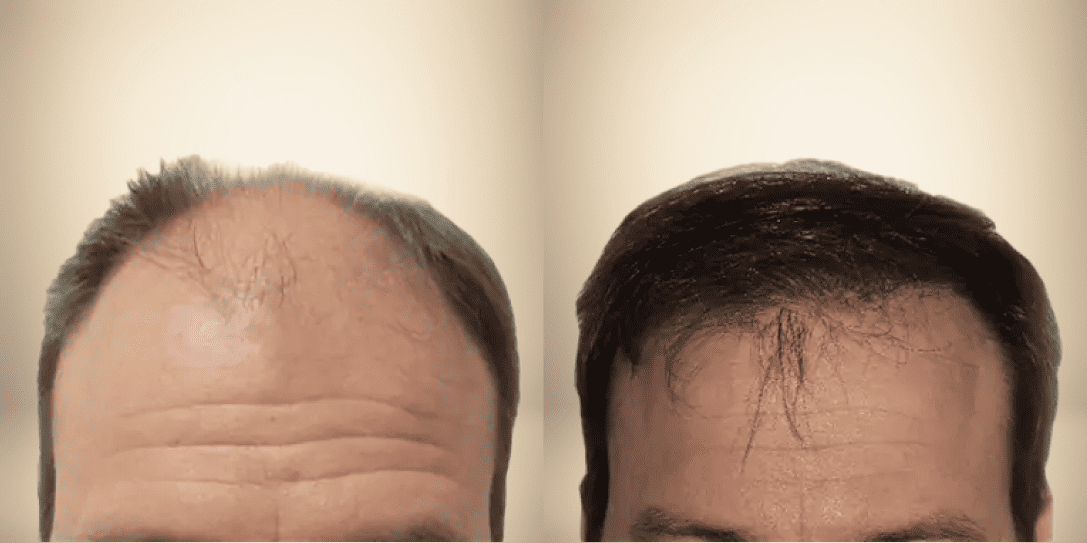 before-and-after-hair-restoration