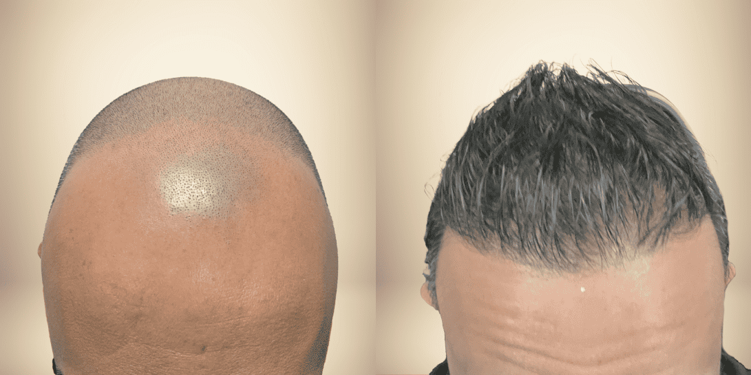 before-and-after-hair-restoration