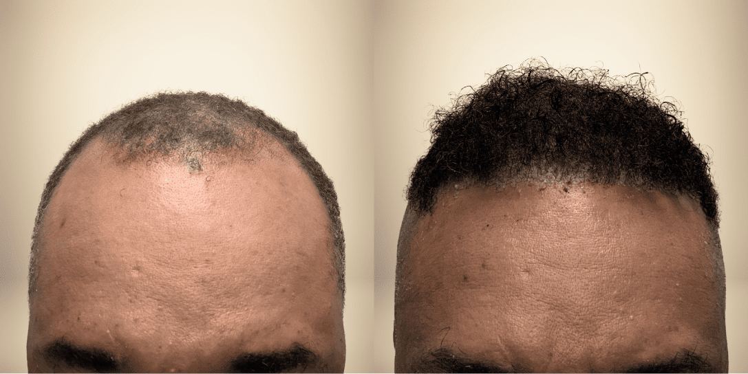 before-and-after-hair-restoration