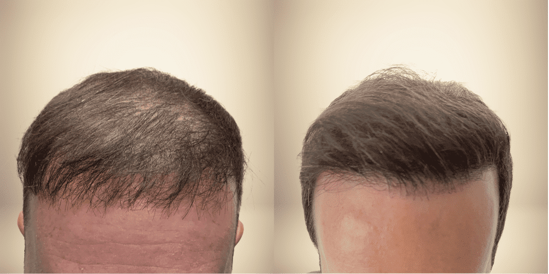 before-and-after-hair-restoration